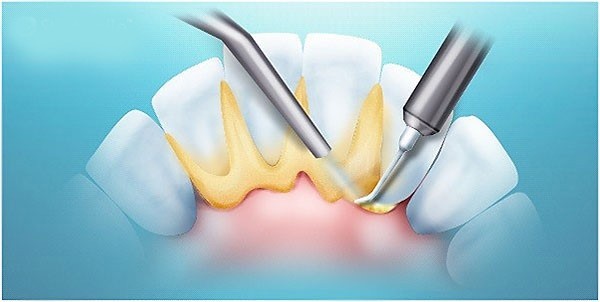 Лечение шатающегося зуба2.jpg