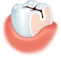 Лечение кариеса зубов ярославль