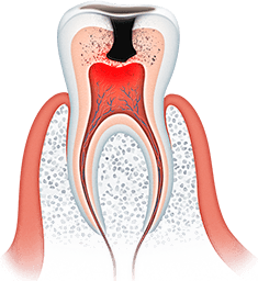 Лечение кариеса зубов ярославль