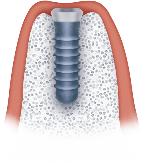 Импалантация зубов в наркозе взрослым Ярославль, поставить зубной имплант