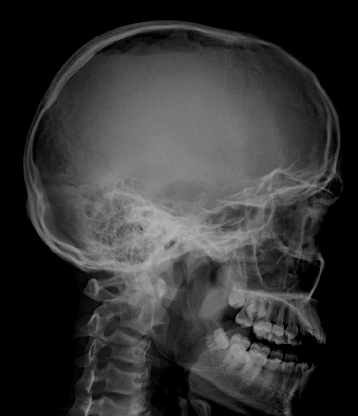 Снимок. Рентгенография черепа (краниография. Кости черепа рентген норма. Рентген черепа сбоку здорового человека. Норма костей черепа на рентгене.
